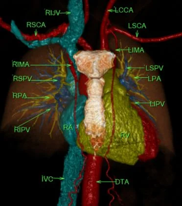 Three-dimensional reconstruction of the thoracic aorta and pulmonary arterial and venous tree with annotated measurement planes