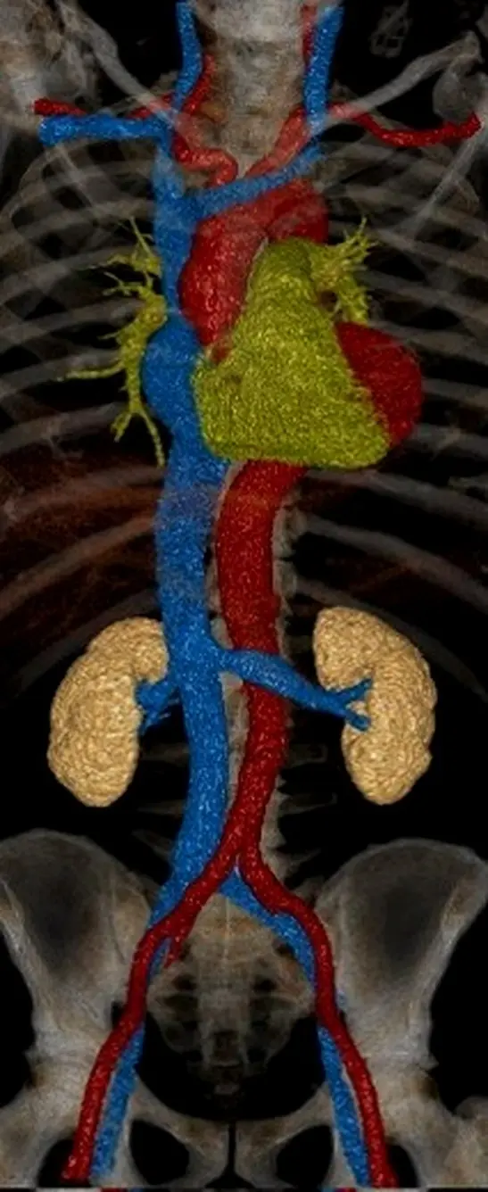Volume-rendered thoracic CT angiogram showing segmented arterial and venous anatomy with an in-situ endovascular stent