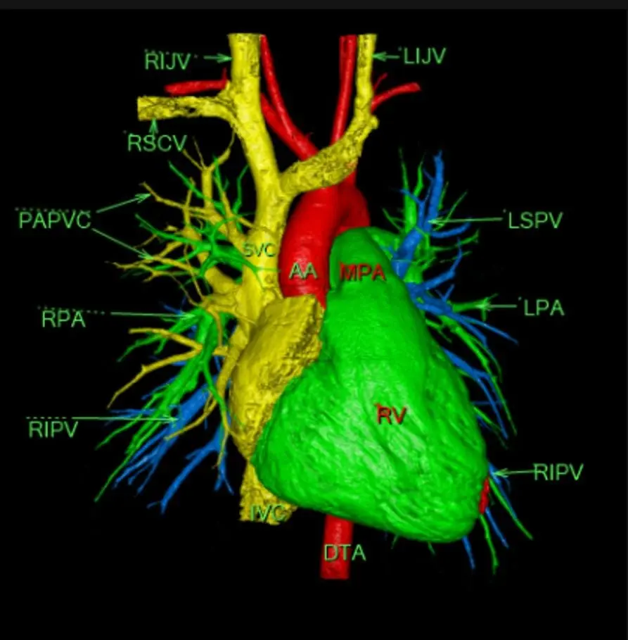 Colour-segmented three-dimensional cardiac model showing myocardium, epicardial fat, coronary arteries, aorta, pulmonary artery and left atrial anatomy